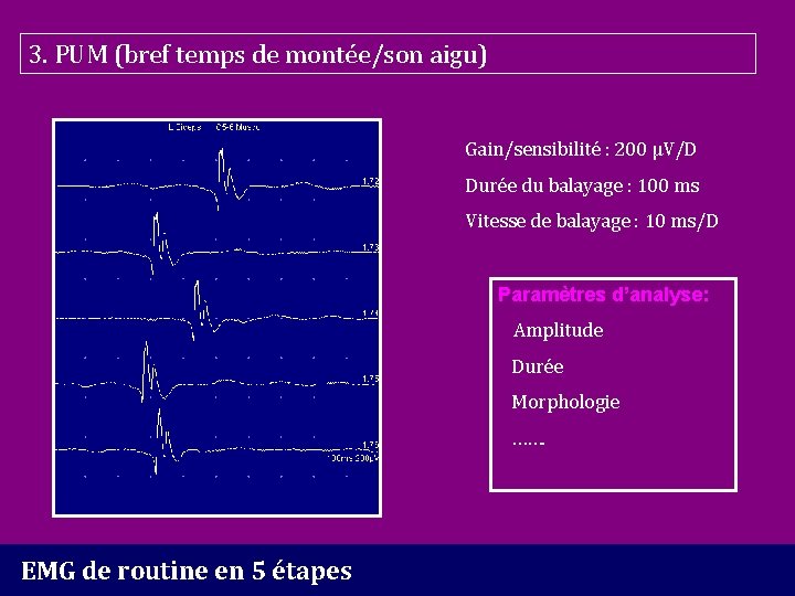 3. PUM (bref temps de montée/son aigu) Gain/sensibilité : 200 µV/D Durée du balayage