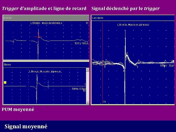 Trigger d’amplitude et ligne de retard Signal déclenché par le trigger PUM moyenné Signal