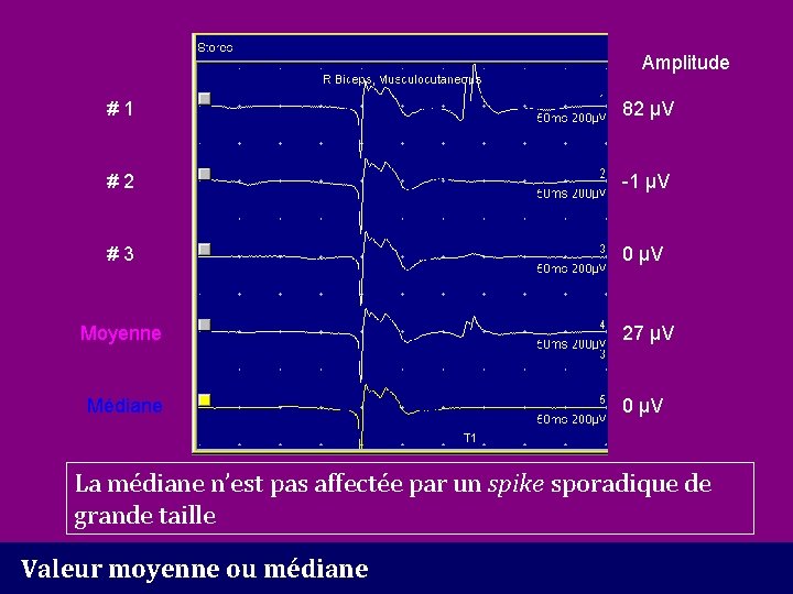 Amplitude #1 82 µV #2 -1 µV #3 0 µV Moyenne 27 µV Médiane