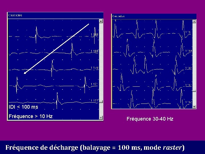 IDI < 100 ms Fréquence > 10 Hz Fréquence 30 -40 Hz Fréquence de