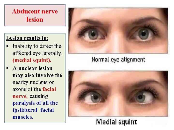 Abducent nerve lesion Lesion results in: § Inability to direct the affected eye laterally.