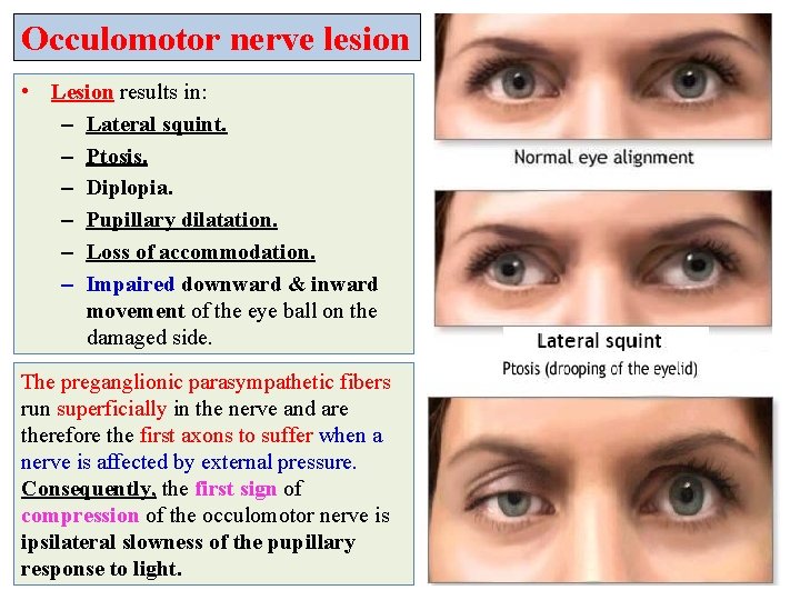 Occulomotor nerve lesion • Lesion results in: – Lateral squint. – Ptosis. – Diplopia.