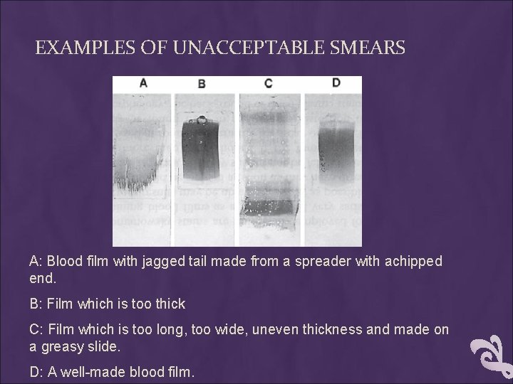 EXAMPLES OF UNACCEPTABLE SMEARS A: Blood film with jagged tail made from a spreader