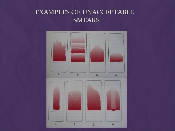 EXAMPLES OF UNACCEPTABLE SMEARS 