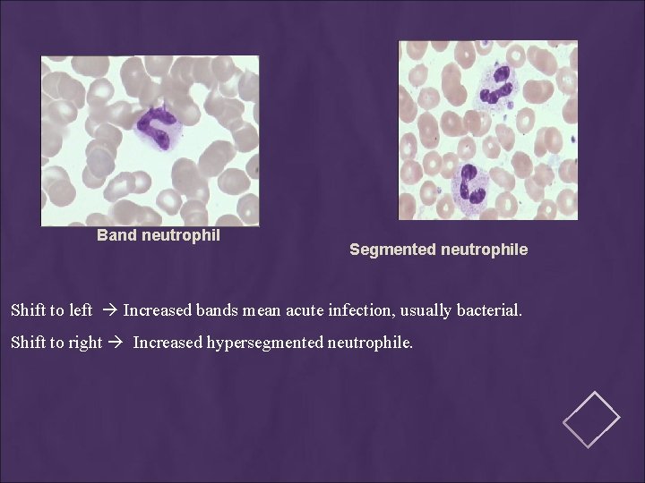 Band neutrophil Segmented neutrophile Shift to left Increased bands mean acute infection, usually bacterial.