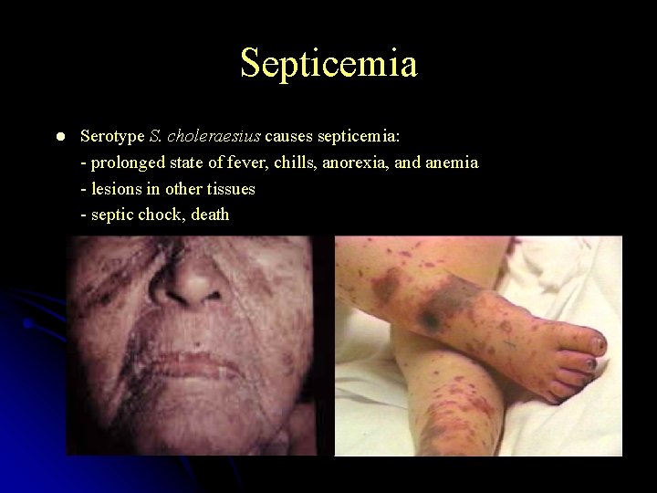 Septicemia l Serotype S. choleraesius causes septicemia: - prolonged state of fever, chills, anorexia,