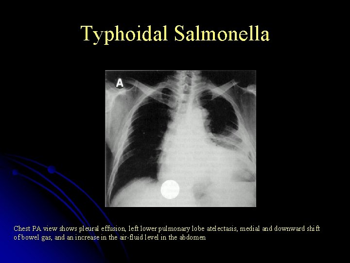 Typhoidal Salmonella Chest PA view shows pleural effusion, left lower pulmonary lobe atelectasis, medial