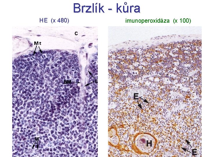 Brzlík - kůra HE (x 480) imunoperoxidáza (x 100) 