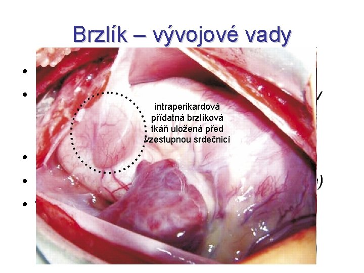 Brzlík – vývojové vady • aplasia thymi • aplasia thymoparathyroidea (Di. Georgův intraperikardová syndrom)