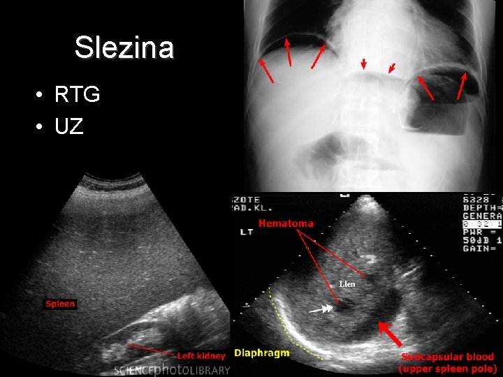 Slezina • RTG • UZ 