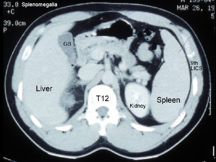 Splenomegalia 