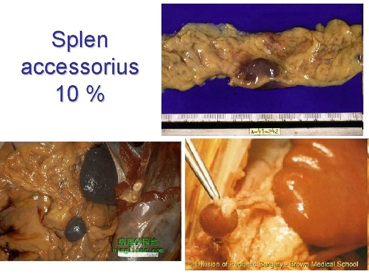 Splen accessorius 10 % 