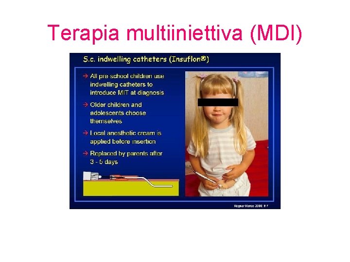 Terapia multiiniettiva (MDI) 