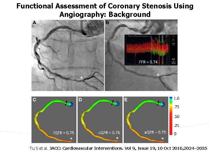 Functional Assessment of Coronary Stenosis Using Angiography: Background Tu S et al. JACC: Cardiovascular