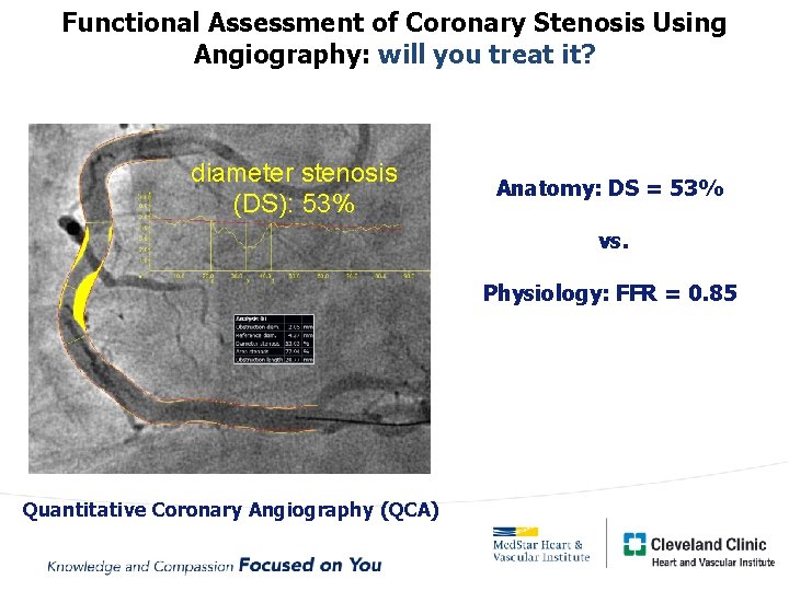 Functional Assessment of Coronary Stenosis Using Angiography: will you treat it? diameter stenosis (DS):