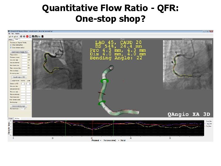 Quantitative Flow Ratio - QFR: One-stop shop? 