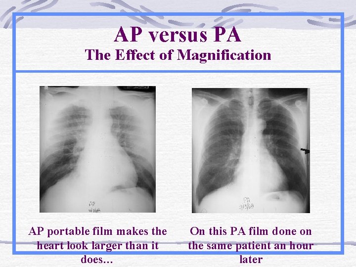 AP versus PA The Effect of Magnification AP portable film makes the heart look