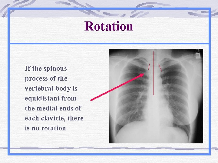 Rotation If the spinous process of the vertebral body is equidistant from the medial