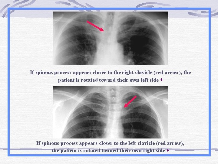 If spinous process appears closer to the right clavicle (red arrow), the patient is
