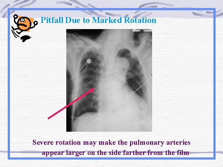 Pitfall Due to Marked Rotation Severe rotation may make the pulmonary arteries appear larger