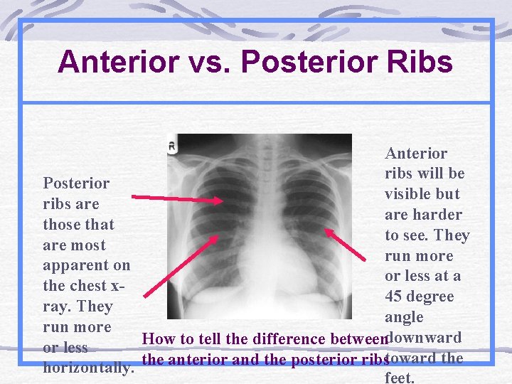 Anterior vs. Posterior Ribs Anterior ribs will be Posterior visible but ribs are harder