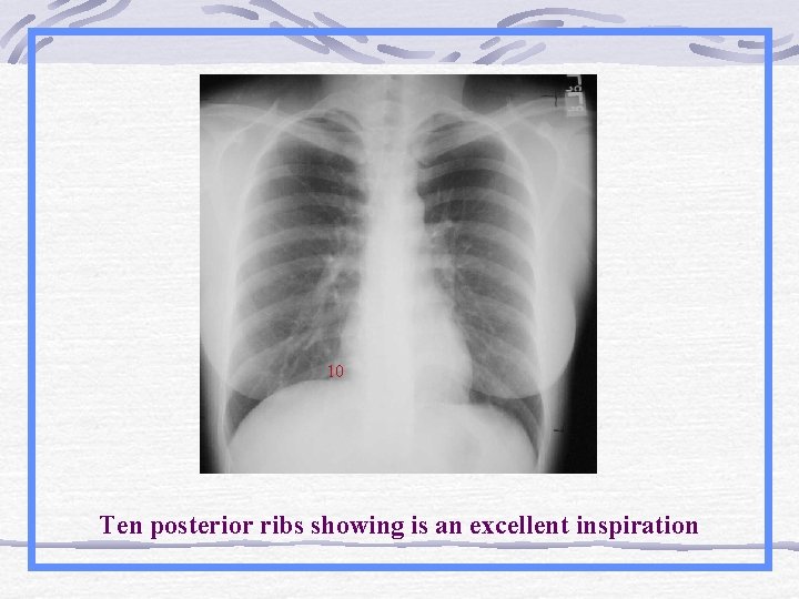10 Ten posterior ribs showing is an excellent inspiration 