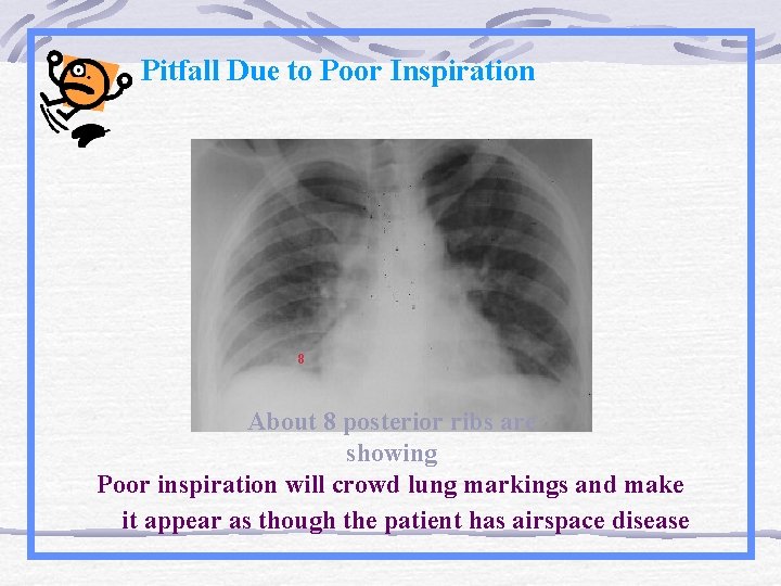 Pitfall Due to Poor Inspiration 8 About 8 posterior ribs are showing Poor inspiration