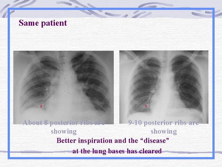 Same patient 8 9 About 8 posterior ribs are 9 -10 posterior ribs are