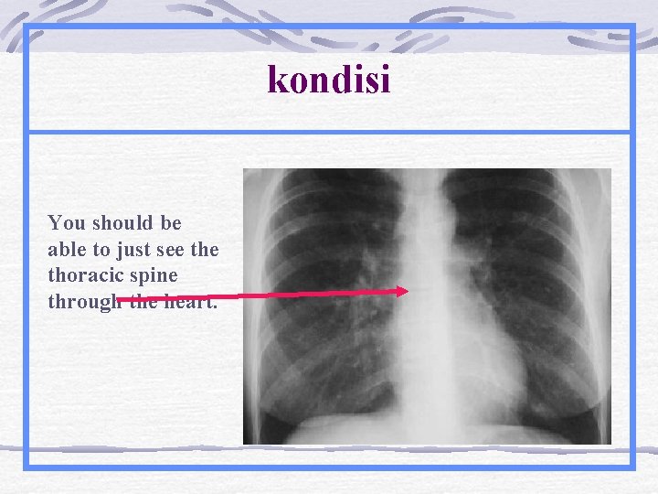 kondisi You should be able to just see thoracic spine through the heart. 