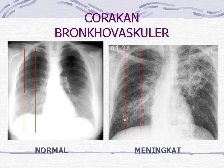 CORAKAN BRONKHOVASKULER NORMAL MENINGKAT 