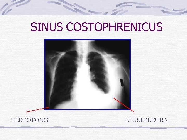 SINUS COSTOPHRENICUS TERPOTONG EFUSI PLEURA 