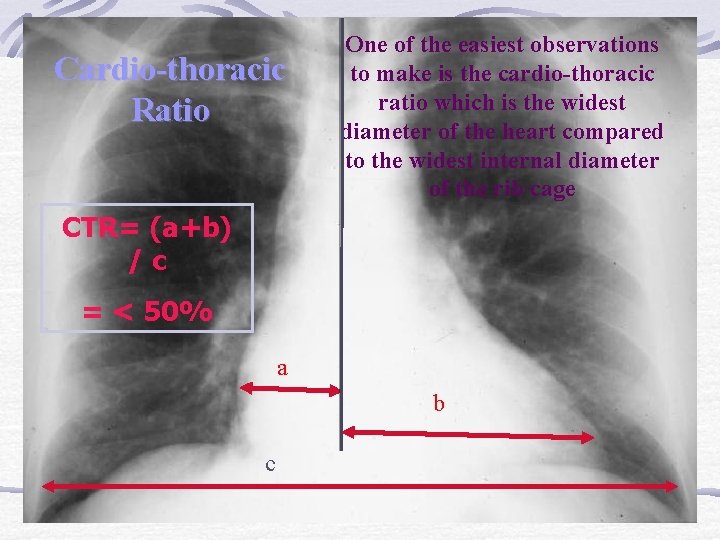 Cardio-thoracic Ratio One of the easiest observations to make is the cardio-thoracic ratio which