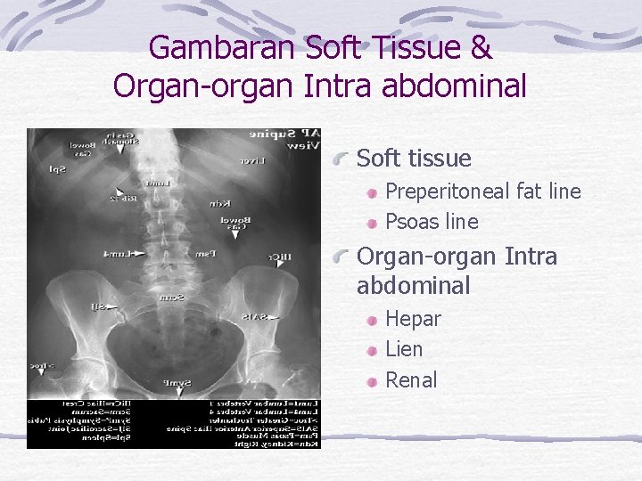 Gambaran Soft Tissue & Organ-organ Intra abdominal Soft tissue Preperitoneal fat line Psoas line