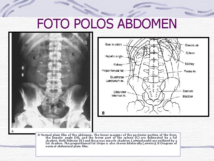 FOTO POLOS ABDOMEN A Normal plain film of the abdomen. The lower margins of