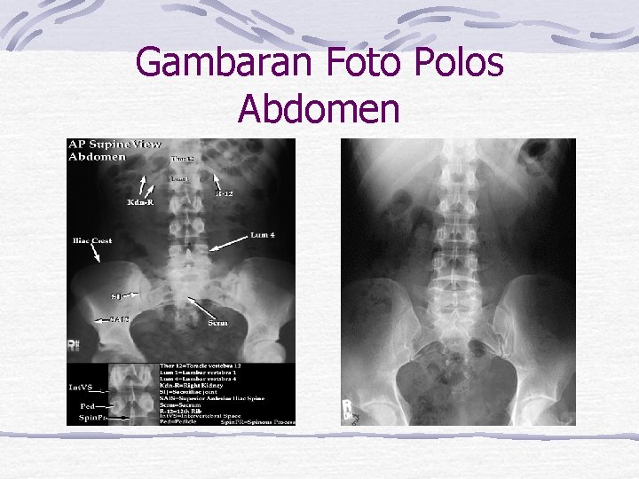 Gambaran Foto Polos Abdomen 