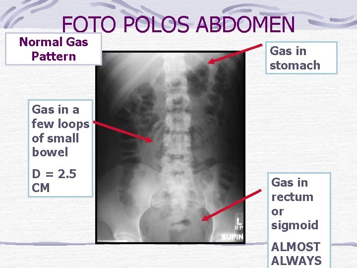 FOTO POLOS ABDOMEN Normal Gas Pattern Gas in stomach Gas in a few loops