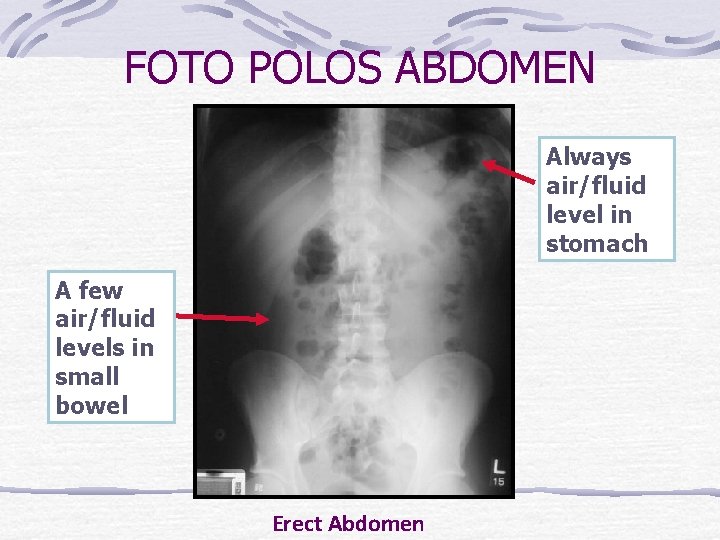 FOTO POLOS ABDOMEN Always air/fluid level in stomach A few air/fluid levels in small