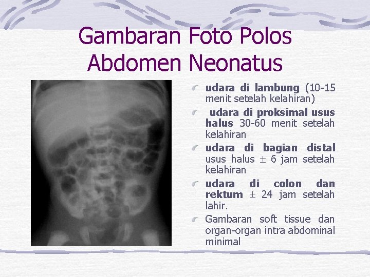 Gambaran Foto Polos Abdomen Neonatus udara di lambung (10 -15 menit setelah kelahiran) udara