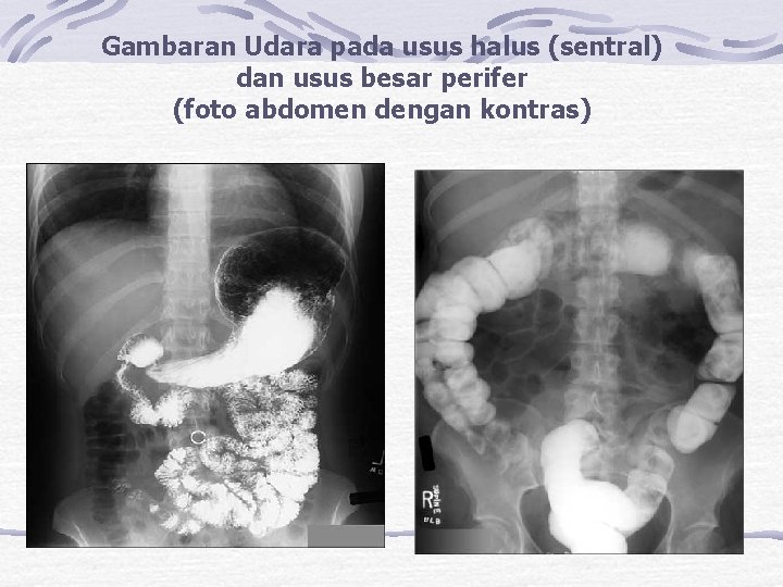 Gambaran Udara pada usus halus (sentral) perifer dan usus besar (foto abdomen dengan kontras)