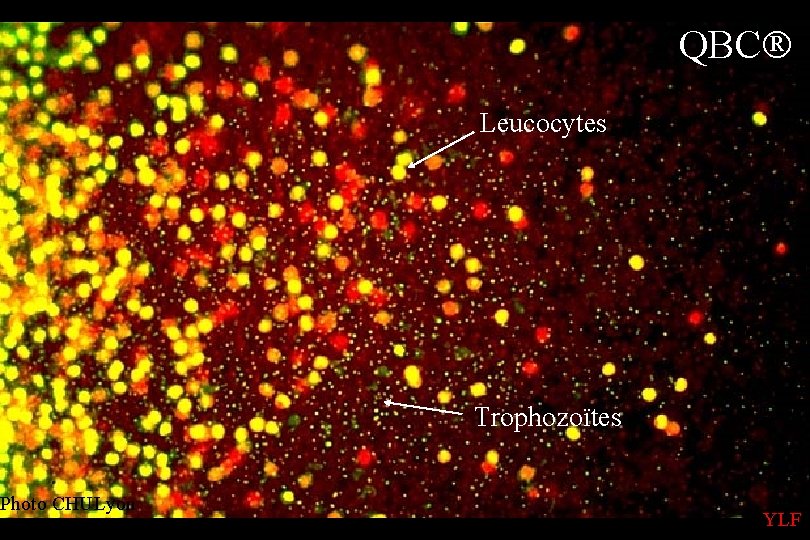 Parasitologie-Mycologie Nice Photo CHULyon Novembre 07 QBC Leucocytes Trophozoïtes YLF 