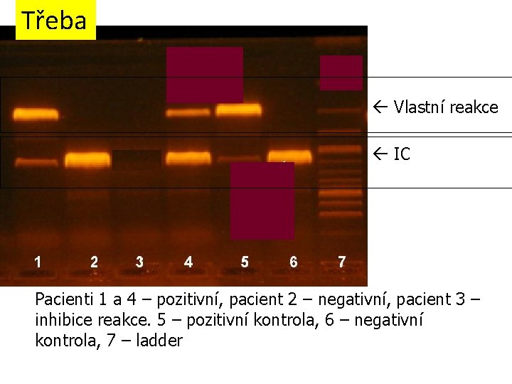 Třeba Vlastní reakce IC Pacienti 1 a 4 – pozitivní, pacient 2 – negativní,