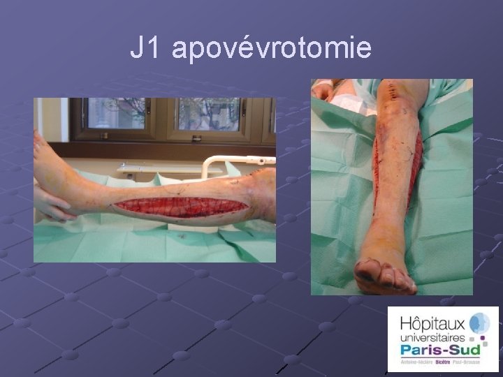 J 1 apovévrotomie 