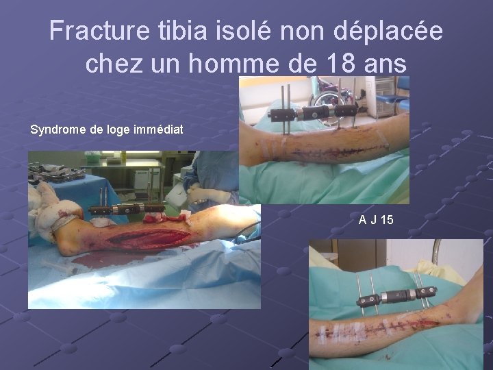 Fracture tibia isolé non déplacée chez un homme de 18 ans Syndrome de loge