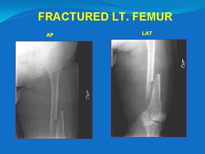FRACTURED LT. FEMUR AP LAT 