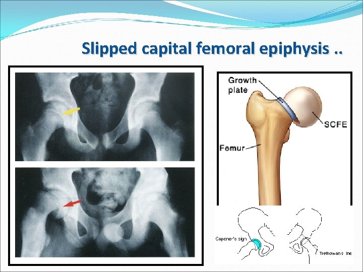 Slipped capital femoral epiphysis. . 