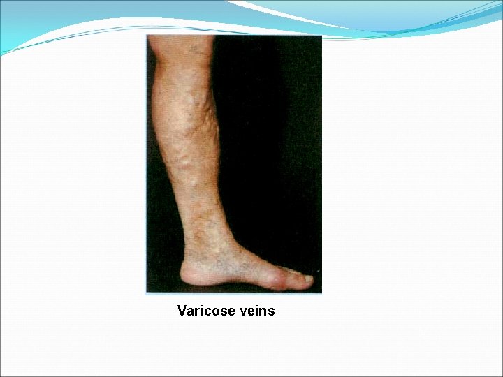 Varicose veins 