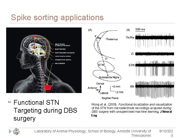 Spike sorting applications Functional STN Targeting during DBS surgery Wong et al. (2009). Functional