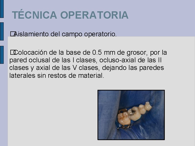 TÉCNICA OPERATORIA �Aislamiento del campo operatorio. �Colocación de la base de 0. 5 mm