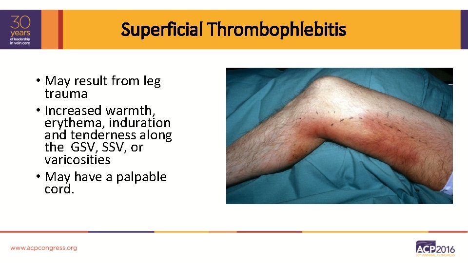 Superficial Thrombophlebitis • May result from leg trauma • Increased warmth, erythema, induration and