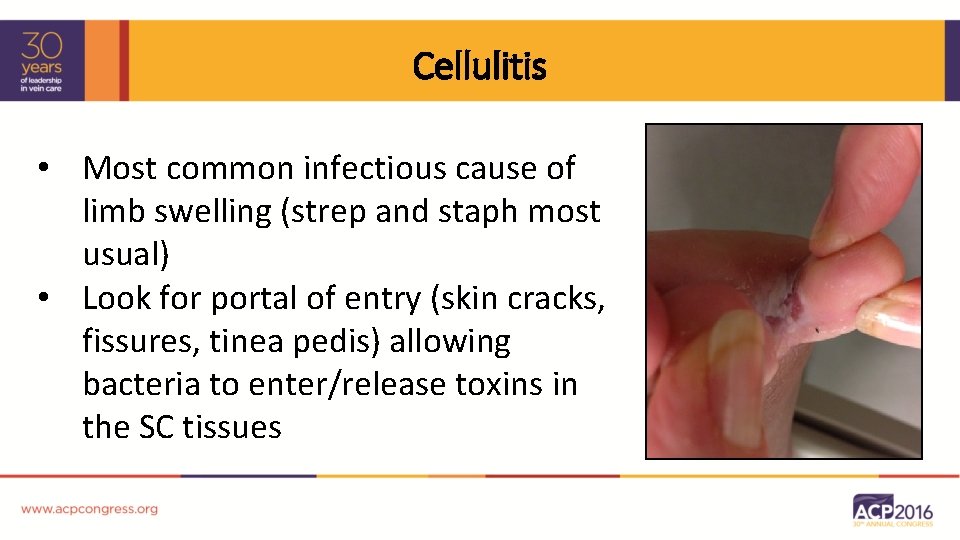 Cellulitis • Most common infectious cause of limb swelling (strep and staph most usual)